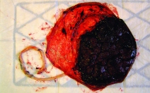 Krvácení v šestinedělí - obrázek